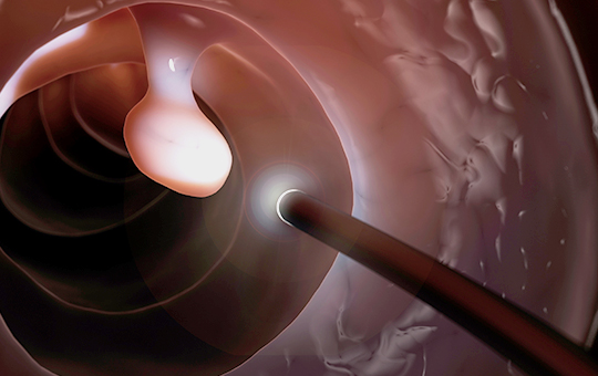 베스트장내과 용종절제술 이미지