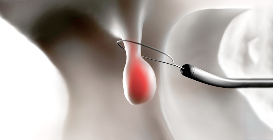 베스트장내과 용종절제술 이미지