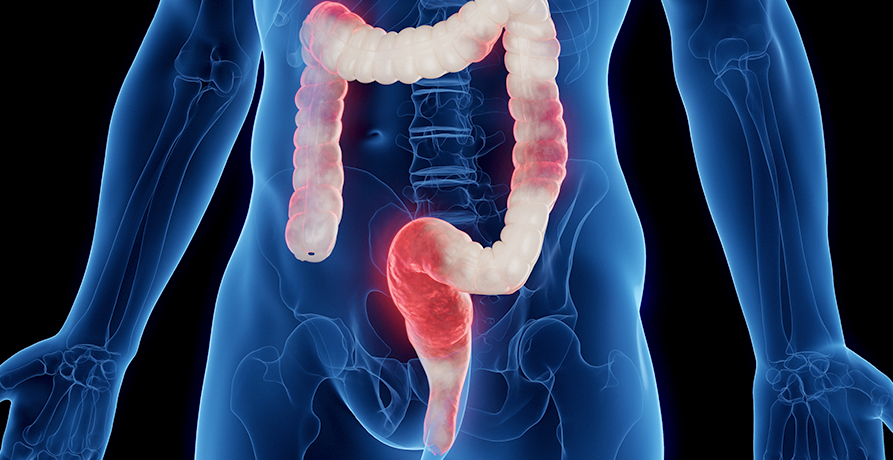 베스트장내과 염증성 장질환 이미지