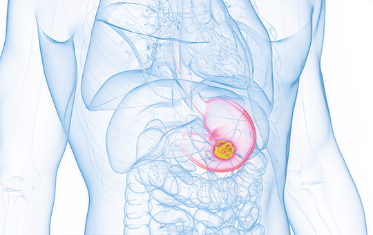 베스트장내과 위암검진