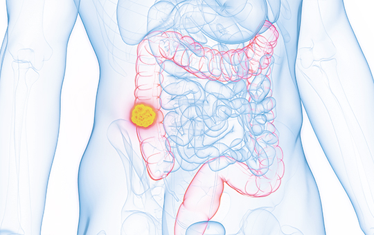 베스트장내과 대장암 검진